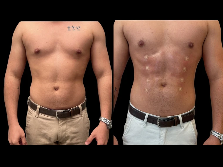 Antes e depois do protocolo Abdômen Supreme
