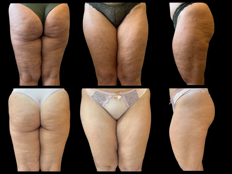 Antes e depois do protocolo de pernas e embelezamento corporal
