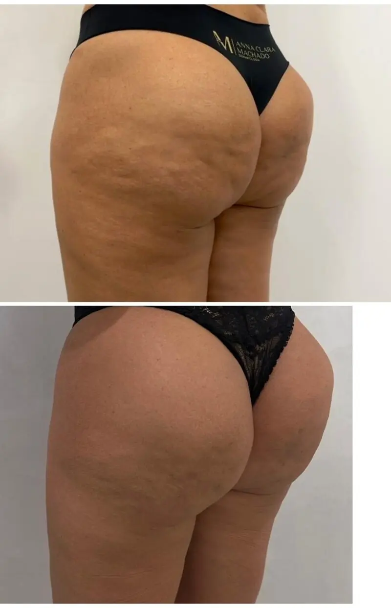 Registro clínico: antes e depois de protocolo de glúteo, vista de perfil