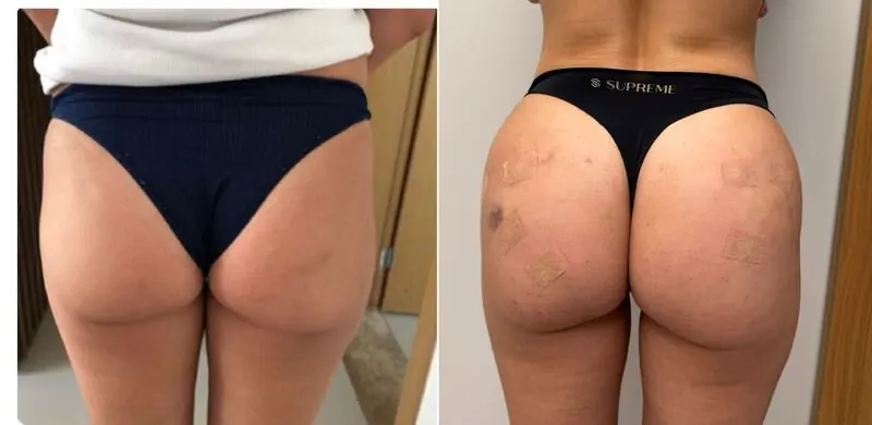 Registro clínico: antes e depois de protocolo de glúteo e pernas
