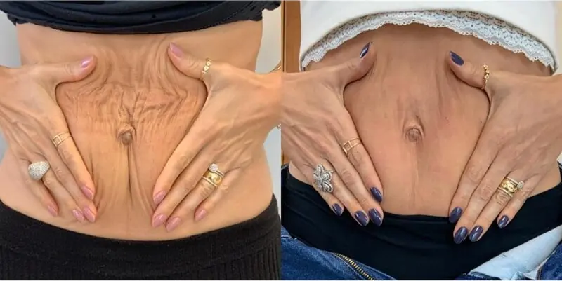 Registro clínico: antes e depois de protocolo para flacidez abdominal